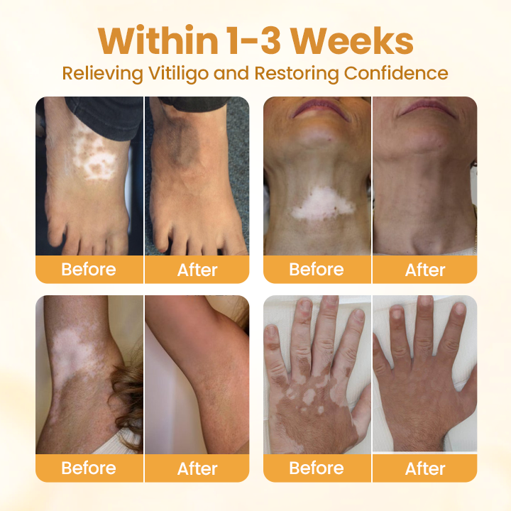 Krem z jadem pszczelim Oveallgo® VitiClear Pro