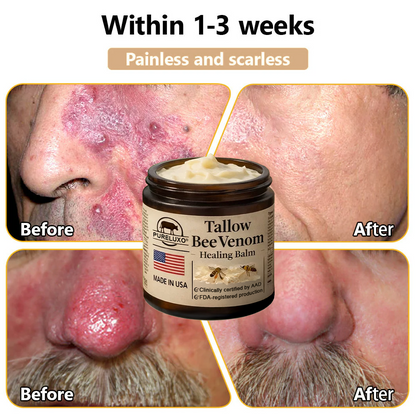 【Kojący】70% kojący】Nadaje się do skóry trądzikowej, zmarszczkowej i uszkodzonej (bez sterydów)