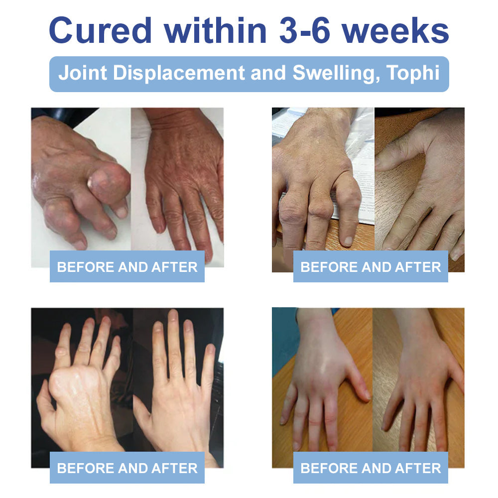 ✅Mayo Clinic Official: Ourlyard® Magnesium Pain Healing Bone Cream (leczenie zapalenia stawów, neuropatii, chorób reumatycznych, skurczów mięśni, drgawek i urazów sportowych)