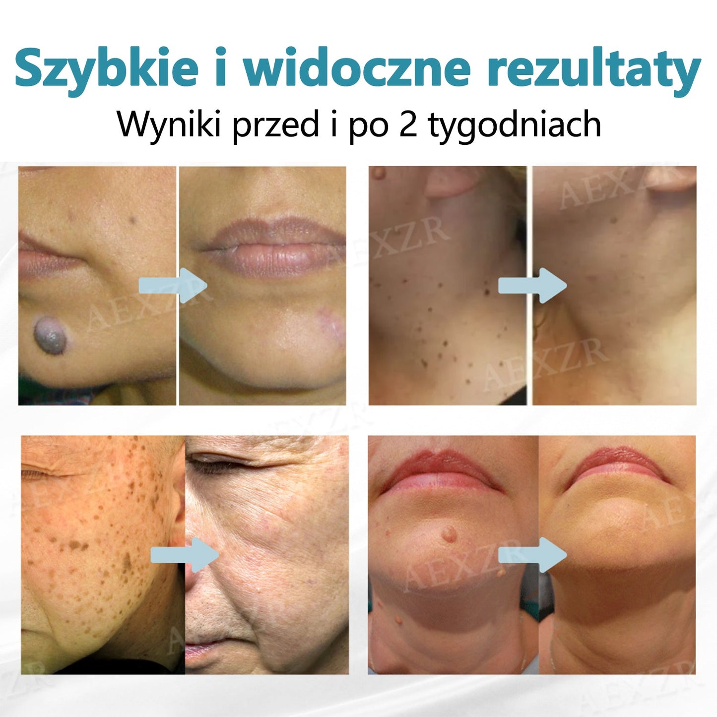 Bikenda® Nieinwazyjny Laserowy Długopis do Usuwania Pieprzyków i Brodawek