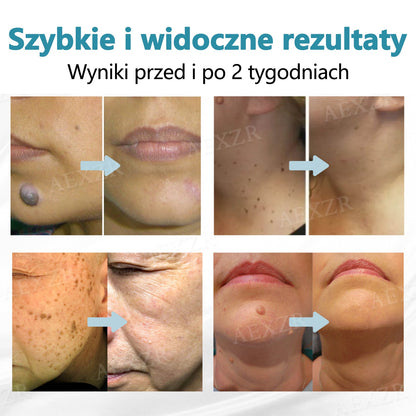 Bikenda® Nieinwazyjny Laserowy Długopis do Usuwania Pieprzyków i Brodawek