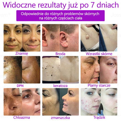 𝐉𝐚𝐬𝐬𝐞𝐞𝐦® Zaawansowany nieinwazyjny laser CO₂ do naprawy skóry 🎉 (Delikatnie usuwa brodawki, znamiona, plamy starcze i narośla skórne – bez bólu, bez zamieszania!)