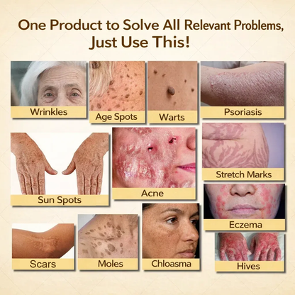 【Kojący】70% kojący】Nadaje się do skóry trądzikowej, zmarszczkowej i uszkodzonej (bez sterydów)