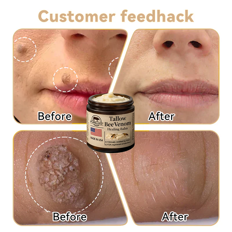 【Kojący】70% kojący】Nadaje się do skóry trądzikowej, zmarszczkowej i uszkodzonej (bez sterydów)