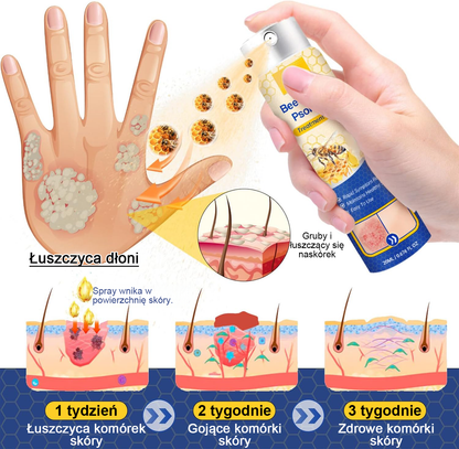 🔥Płatność przy odbiorze🔥60% zniżki) LOVILDS™ PsoriaHeal Spray na łuszczycę (wysyłka na cały świat – bezpłatna wysyłka