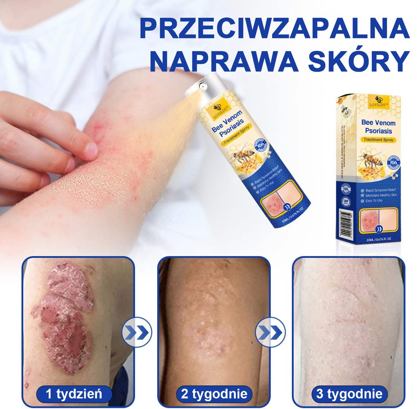 🔥Płatność przy odbiorze🔥60% zniżki) LOVILDS™ PsoriaHeal Spray na łuszczycę (wysyłka na cały świat – bezpłatna wysyłka