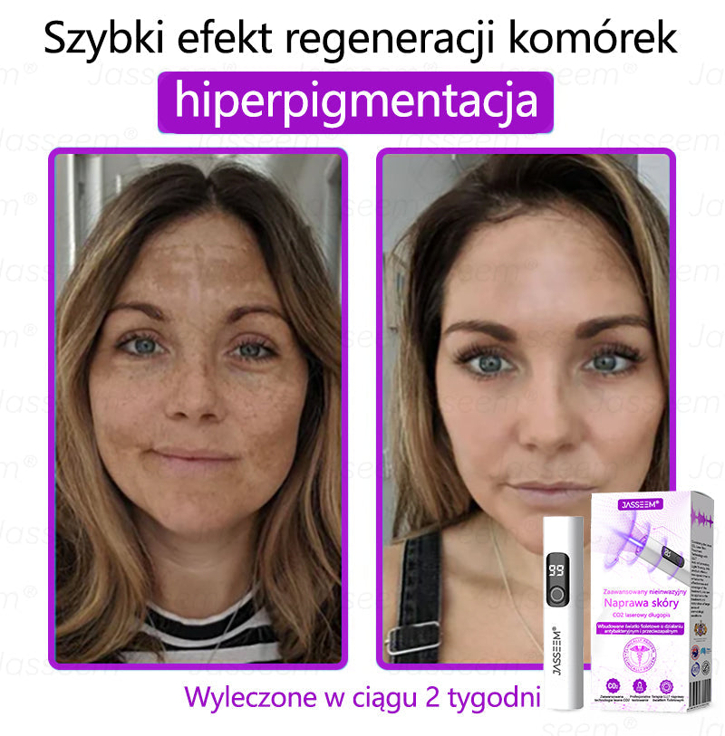 𝐉𝐚𝐬𝐬𝐞𝐞𝐦® Zaawansowany nieinwazyjny laser CO₂ do naprawy skóry 🎉 (Delikatnie usuwa brodawki, znamiona, plamy starcze i narośla skórne – bez bólu, bez zamieszania!)