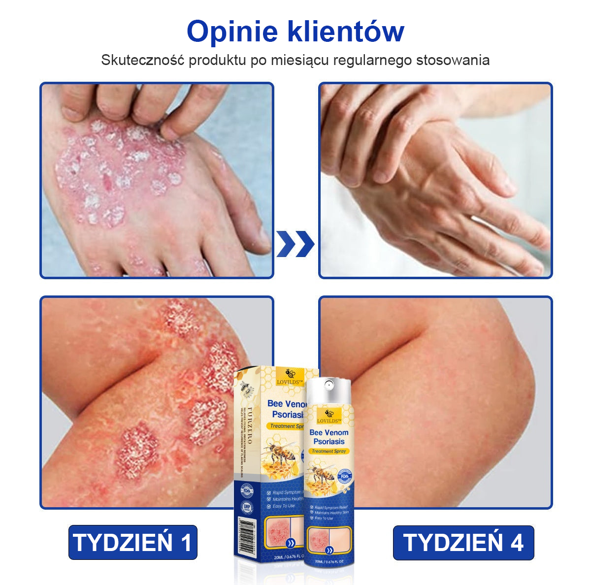🔥Płatność przy odbiorze🔥60% zniżki) LOVILDS™ PsoriaHeal Spray na łuszczycę (wysyłka na cały świat – bezpłatna wysyłka