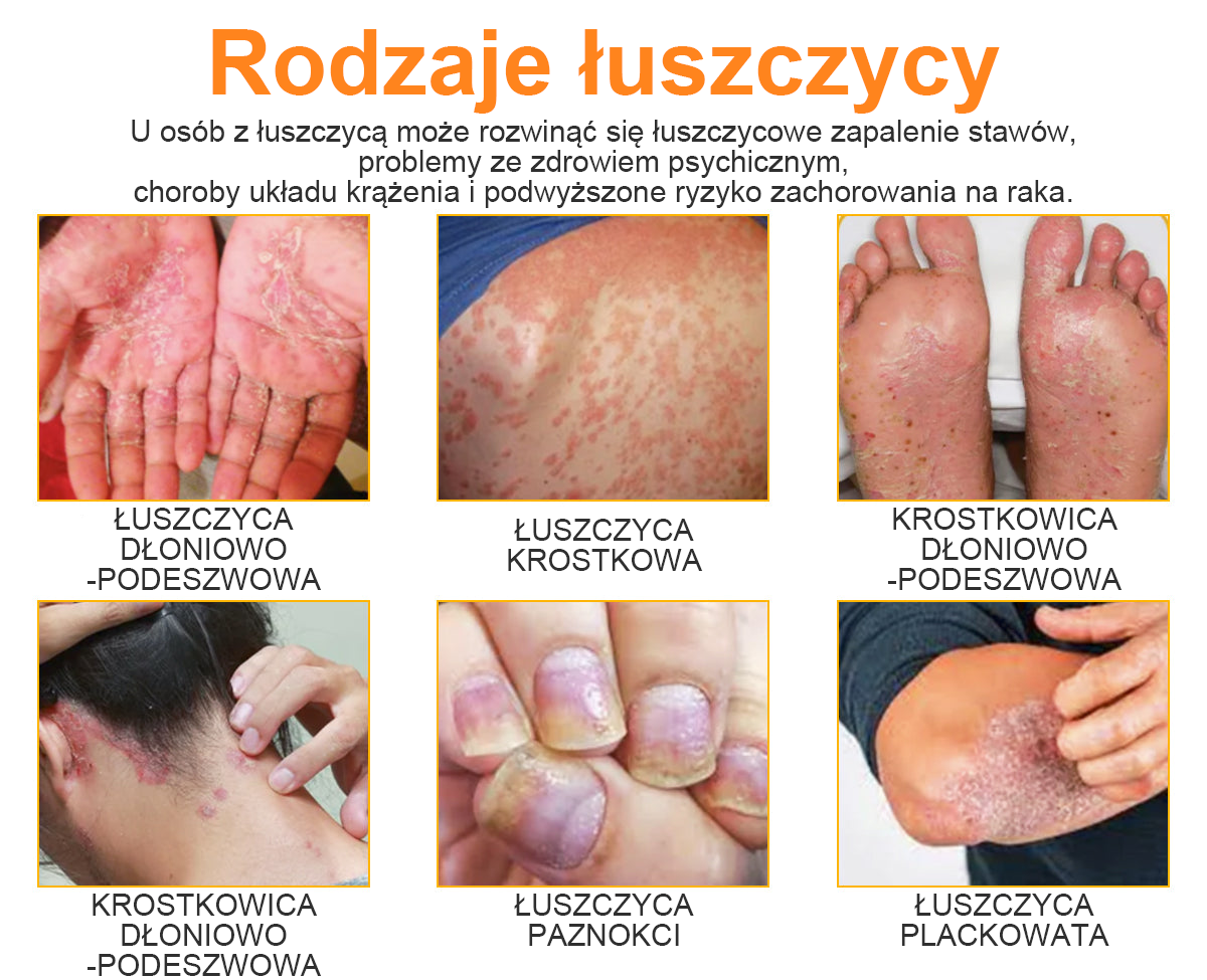 🔥Płatność przy odbiorze🔥60% zniżki) LOVILDS™ PsoriaHeal Spray na łuszczycę (wysyłka na cały świat – bezpłatna wysyłka