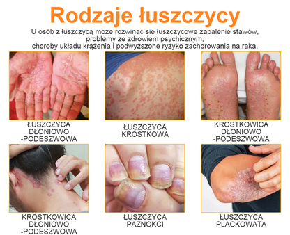 🔥Płatność przy odbiorze🔥60% zniżki) LOVILDS™ PsoriaHeal Spray na łuszczycę (wysyłka na cały świat – bezpłatna wysyłka