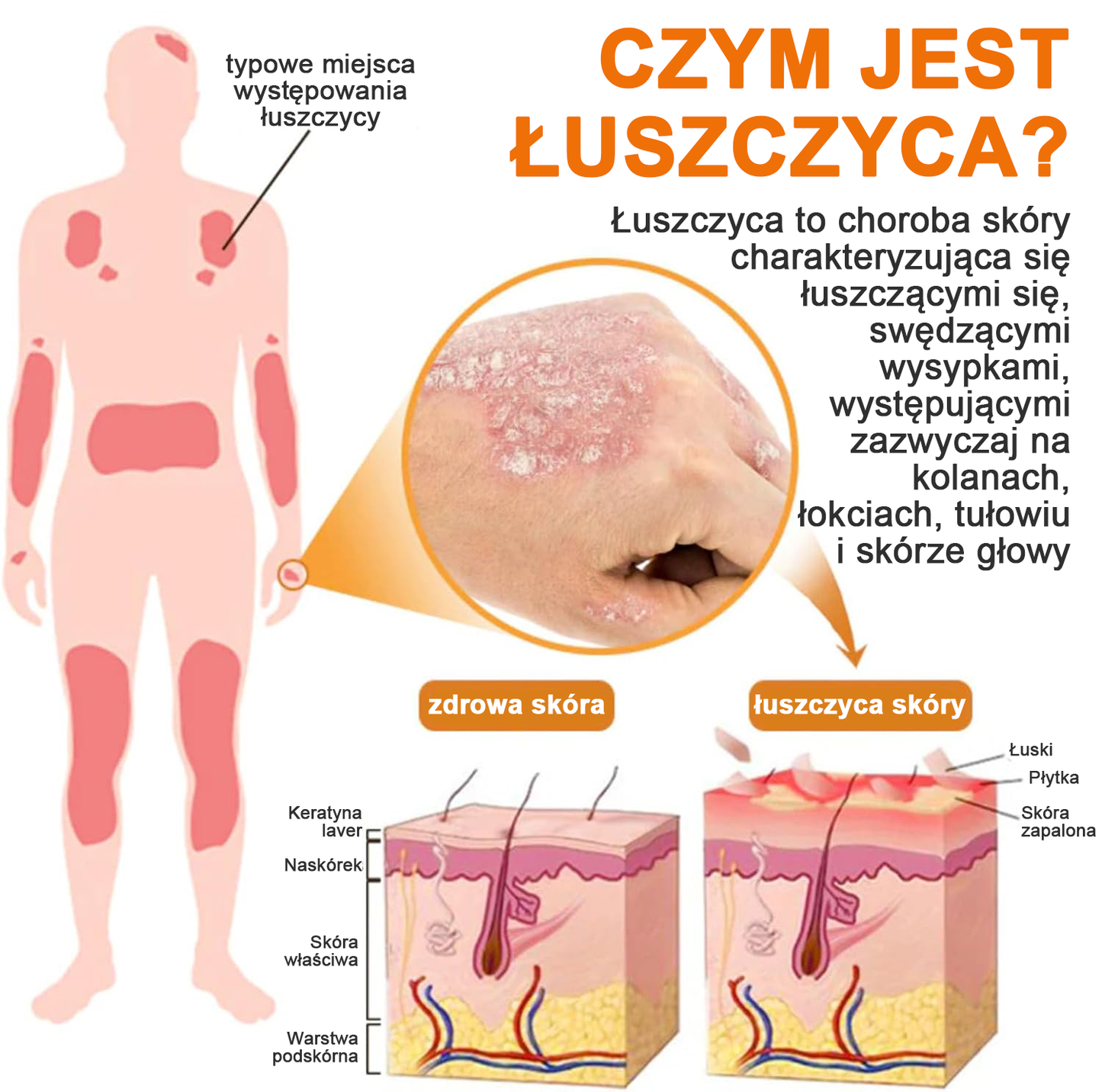 🔥Płatność przy odbiorze🔥60% zniżki) LOVILDS™ PsoriaHeal Spray na łuszczycę (wysyłka na cały świat – bezpłatna wysyłka