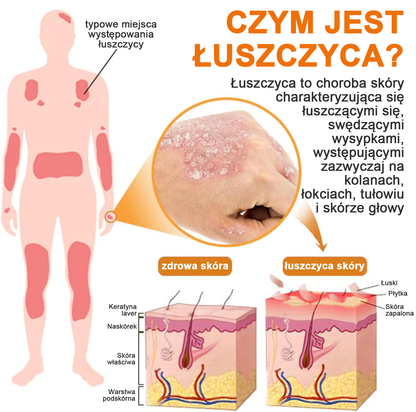 🔥Płatność przy odbiorze🔥60% zniżki) LOVILDS™ PsoriaHeal Spray na łuszczycę (wysyłka na cały świat – bezpłatna wysyłka