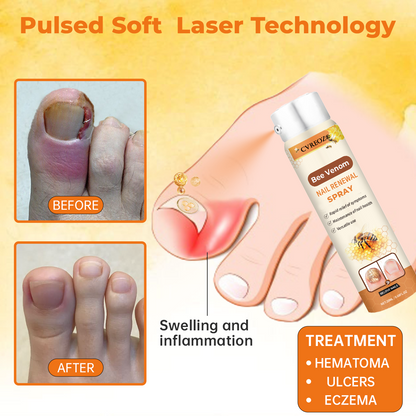 Cvreoz®Bee Venom Nail Renewal Spray👨‍⚕️ 𝘾𝙚𝙧𝙩𝙞𝙛𝙞𝙚𝙙 𝙗𝙮 𝙩𝙝𝙚 𝘼𝙢𝙚𝙧𝙞𝙘𝙖𝙣 𝘼𝙘𝙖𝙙𝙚𝙢𝙮 𝙤𝙛 𝘿𝙚𝙧𝙢𝙖𝙩𝙤𝙡𝙤𝙜𝙮(𝘼𝘼𝘿)